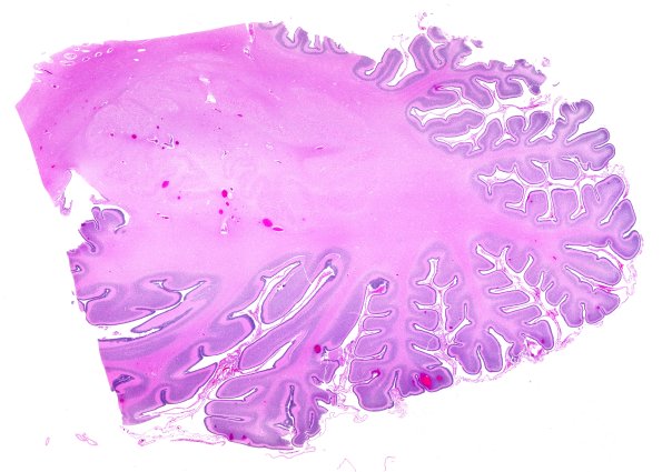4B1 Menkes Dz (Case 4) H&E WM