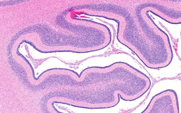 4B2 Menkes Dz (Case 4) H&E 4XA