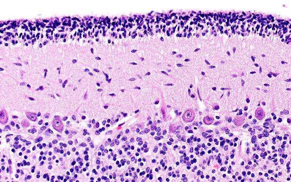 4B3 Menkes Dz (Case 4) H&E 40X