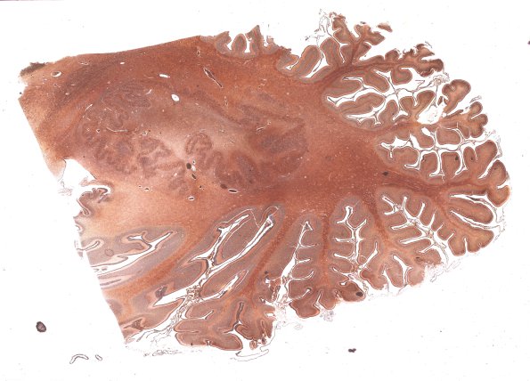 4C1 Menkes Dz (Case 4) Biels WM