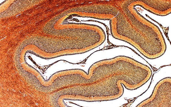 4C2 Menkes Dz (Case 4) Biels 4X 1A