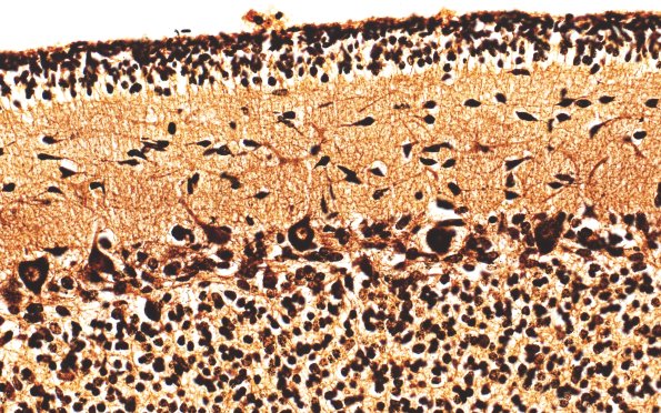 4C3 Menkes Dz (Case 4) Biels 40X 1