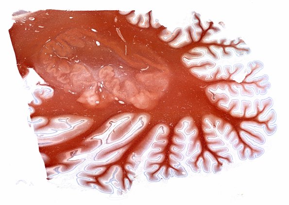 4D1 Menkes Dz (Case 4) NF WM