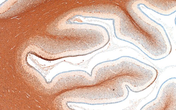 4D2 Menkes Dz (Case 4) NF 4X