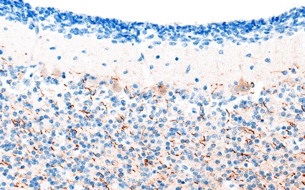 4D3 Menkes Dz (Case 4) NF 40X 3