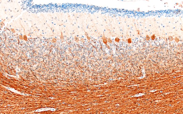 4D4 Menkes Dz (Case 4) NF 20X