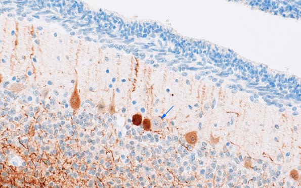 4D5 Menkes Dz (Case 4) NF 40X 4 copy