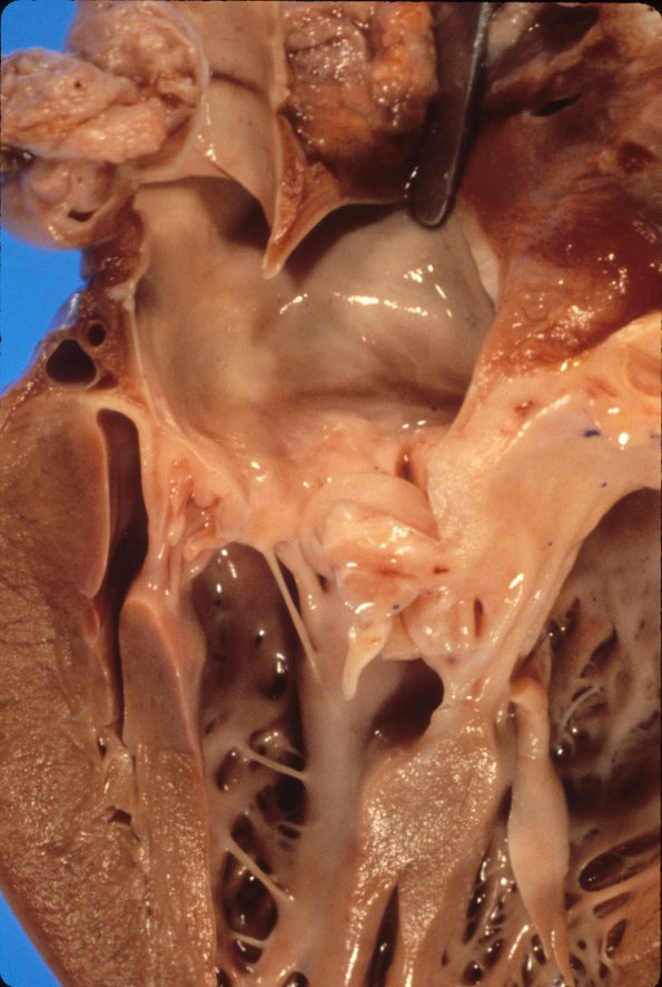 1A2 Mucopolysaccharidosis, Hunter Dz (Case 1) 8