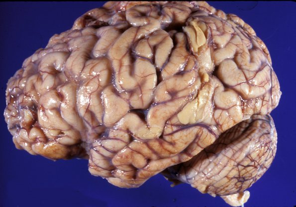 1B1 Mucopolysaccharidosis, Hunter Dz (Case 1) 2A