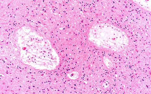 1B10 Mucopolysaccharidosis, Hunter Dz (Case 1) H&E Cortex 4