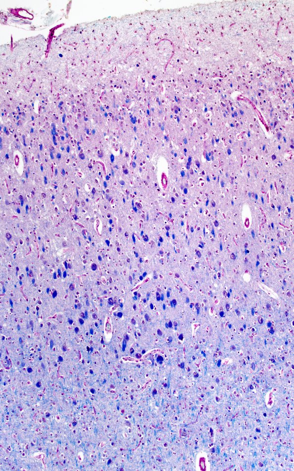 1B12 Mucopolysaccharidosis, Hunter Dz (Case 1) LFB-PAS Frontal cortex 2