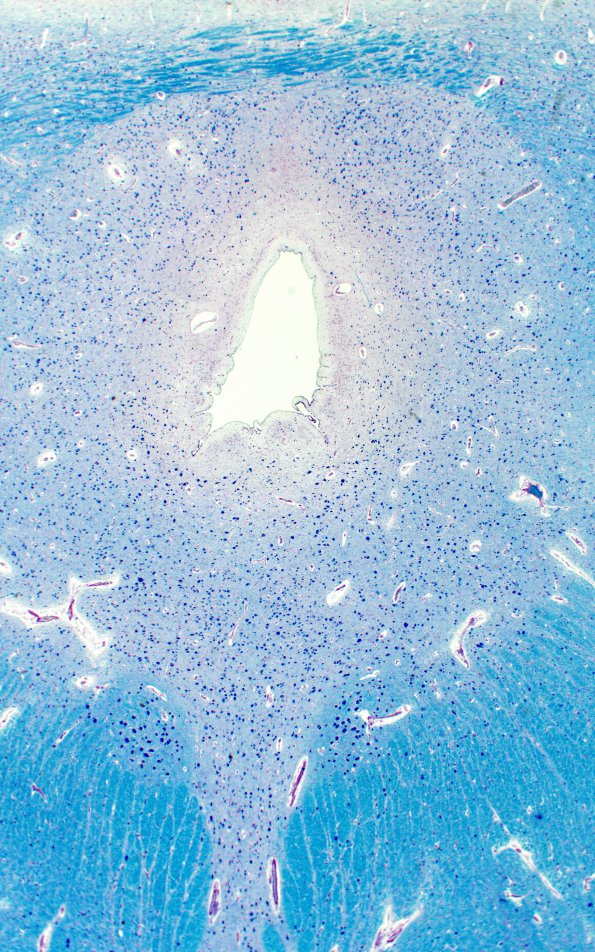 1B15 Mucopolysaccharidosis, Hunter Dz (Case 1) LFB-PAS Midbrain 3