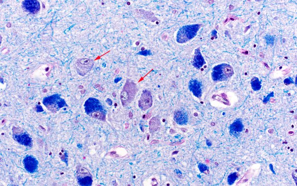 1B16 Mucopolysaccharidosis, Hunter Dz (Case 1) LFB-PAS Midbrain 1 copy