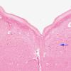 1B17 Mucopolysaccharidosis, Hunter Dz (Case 1) Medulla XII nucleus H&E 4X copy