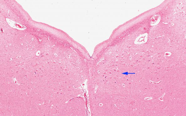 1B17 Mucopolysaccharidosis, Hunter Dz (Case 1) Medulla XII nucleus H&E 4X copy