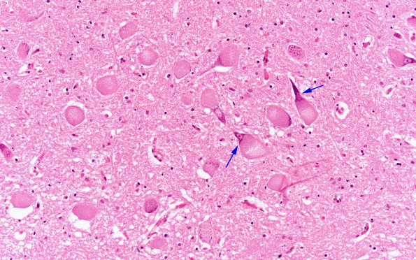 1B18 Mucopolysaccharidosis, Hunter Dz (Case 1) Medulla XII nucleus H&E 20X copy