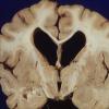 1B3 Mucopolysaccharidosis, Hunter Dz (Case 1) 4