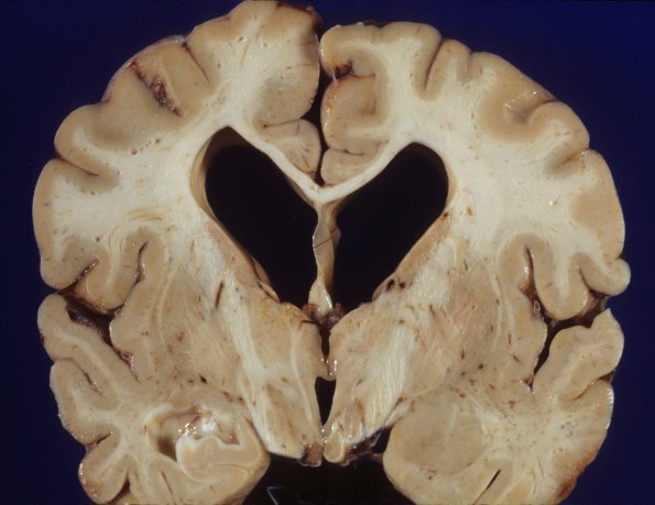 1B3 Mucopolysaccharidosis, Hunter Dz (Case 1) 4