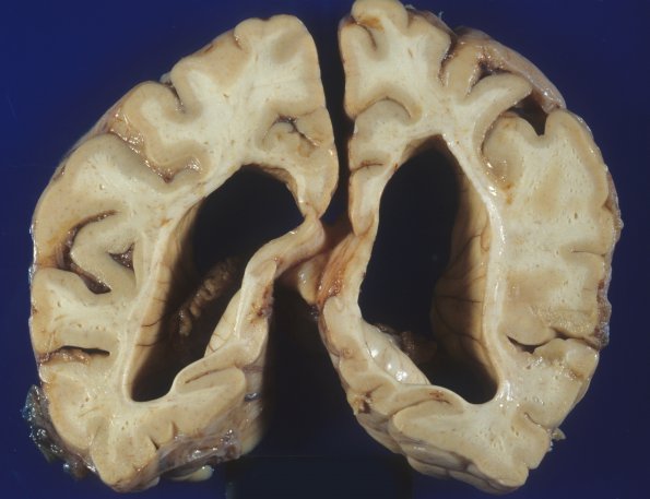 1B4 Mucopolysaccharidosis, Hunter Dz (Case 1) 5