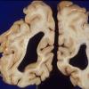 1B5 Mucopolysaccharidosis, Hunter Dz (Case 1) 1