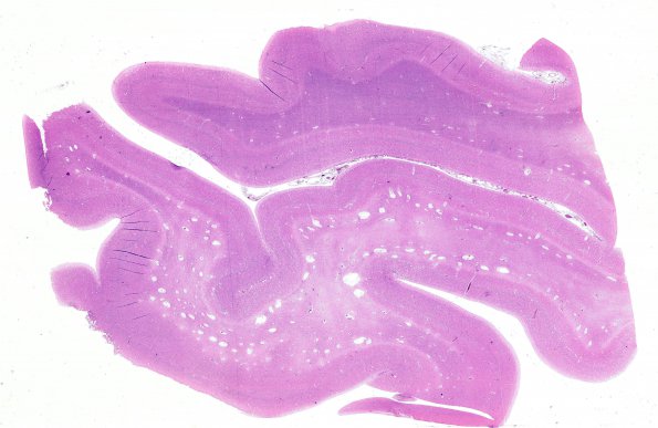 1B8 Mucopolysaccharidosis, Hunter Dz (Case 1) H&E Cortex 1