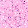 1B9 Mucopolysaccharidosis, Hunter Dz (Case 1) H&E Cortex 2 copy