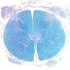 1C1 Mucopolysaccharidosis, Hunter Dz (Case 1) LFB-PAS 3