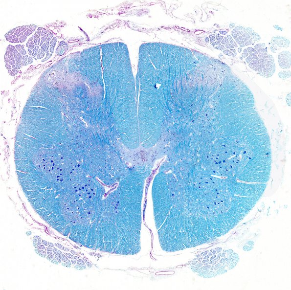 1C1 Mucopolysaccharidosis, Hunter Dz (Case 1) LFB-PAS 3