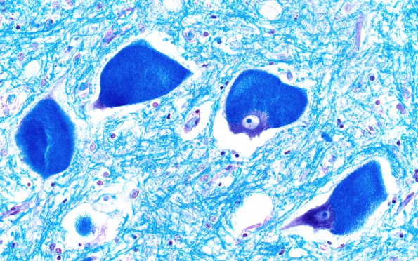 1C2 Mucopolysaccharidosis, Hunter Dz Case 1) LFB-PAS 8