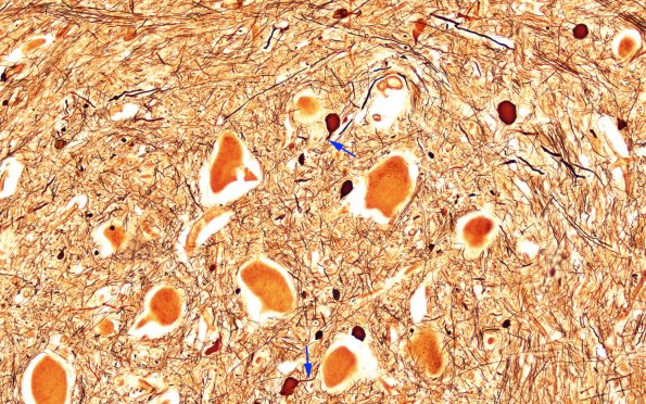 1C3 Mucopolysaccharidosis, Hunter Dz Case 1) Bielschowsky 8 copy