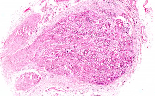 1D1 Mucopolysaccharidosis, Hunter Dz Case 1) DRG H&E 1