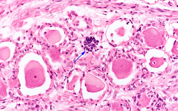 1D2 Mucopolysaccharidosis, Hunter Dz Case 1) DRG H&E 11 copy