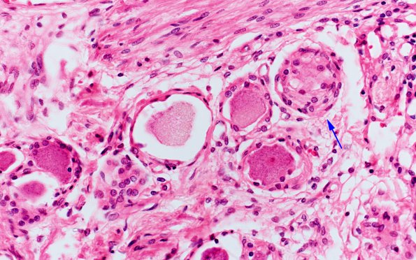 1D3 Mucopolysaccharidosis, Hunter Dz Case 1) DRG H&E 3 copy