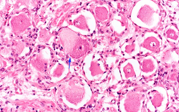 1D4 Mucopolysaccharidosis, Hunter Dz Case 1) DRG H&E 15 copy