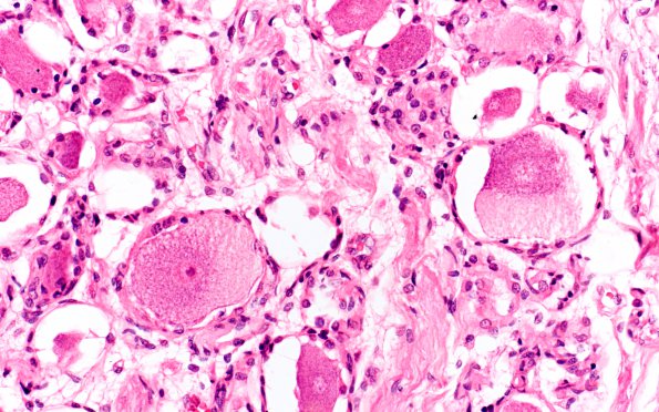 1D5 Mucopolysaccharidosis, Hunter Dz Case 1) DRG H&E 12