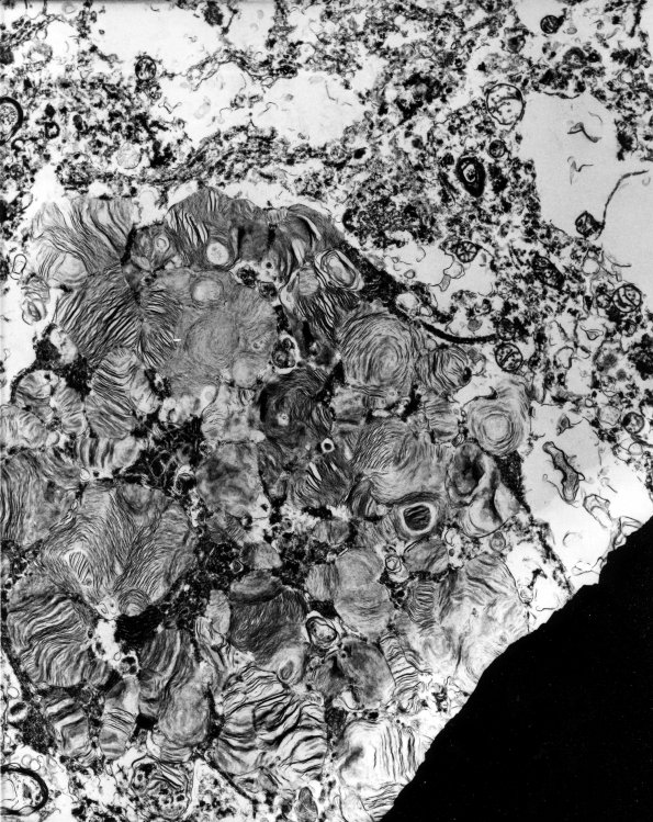 1E1 Mucopolysaccharidosis, Hunter Dz (Case 1) EM 1 - Copy A