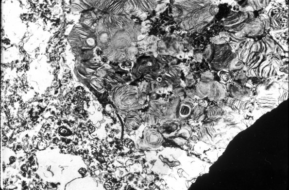 1E3 Mucopolysaccharidosis, Hunter Dz (Case 1) EM3 Zebra body - Copy A