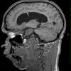 2A1 Mucopolysaccharidosis, Hurler Dz (Case 2) T1 MPR NS SAG copy