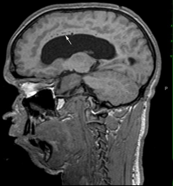 2A1 Mucopolysaccharidosis, Hurler Dz (Case 2) T1 MPR NS SAG copy