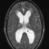 2A3 Mucopolysaccharidosis (Case 2) T2 copy