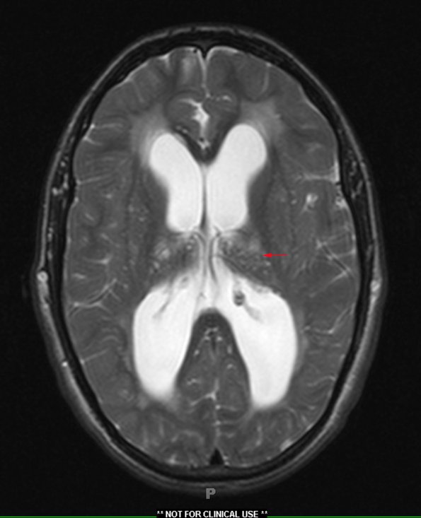 2A3 Mucopolysaccharidosis (Case 2) T2 copy