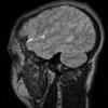 2A4 Mucopolysaccharidosis, Hurler Dz (Case 2) T2 TSE SAG & C