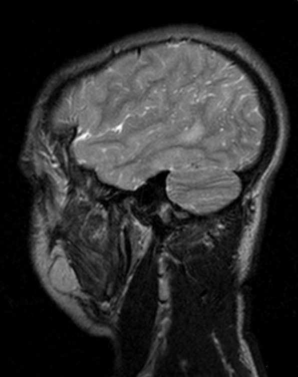 2A4 Mucopolysaccharidosis, Hurler Dz (Case 2) T2 TSE SAG & C