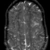 2A5 Mucopolysaccharidosis, Hurler Dz (Case 2) TSE T2 AXIAL 3