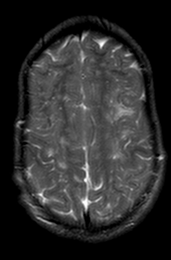 2A5 Mucopolysaccharidosis, Hurler Dz (Case 2) TSE T2 AXIAL 3