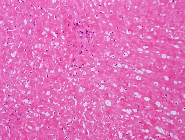 2B1 Mucopolysaccharidosis, Hurler Dz (Case 2) H&E 4