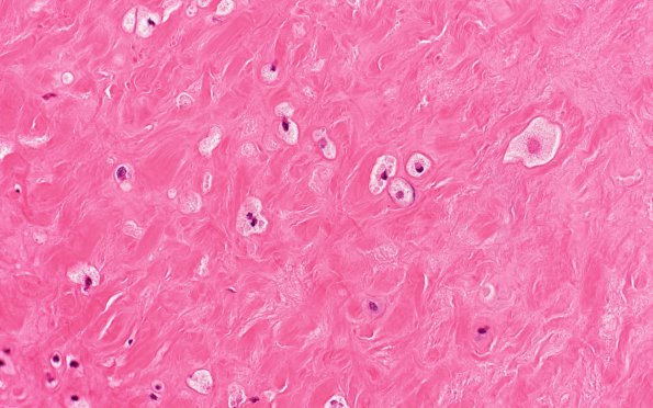 2B2 Mucopolysaccharidosis, Hurler Dz (Case 2) H&E 1