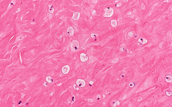 2B3 Mucopolysaccharidosis, Hurler Dz (Case 2) H&E 2