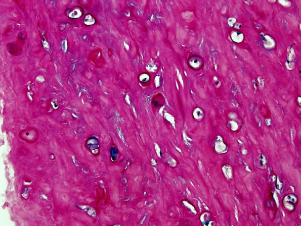 2B4 Mucopolysaccharidosis, Hurler Dz (Case 2) ABPAS-4m