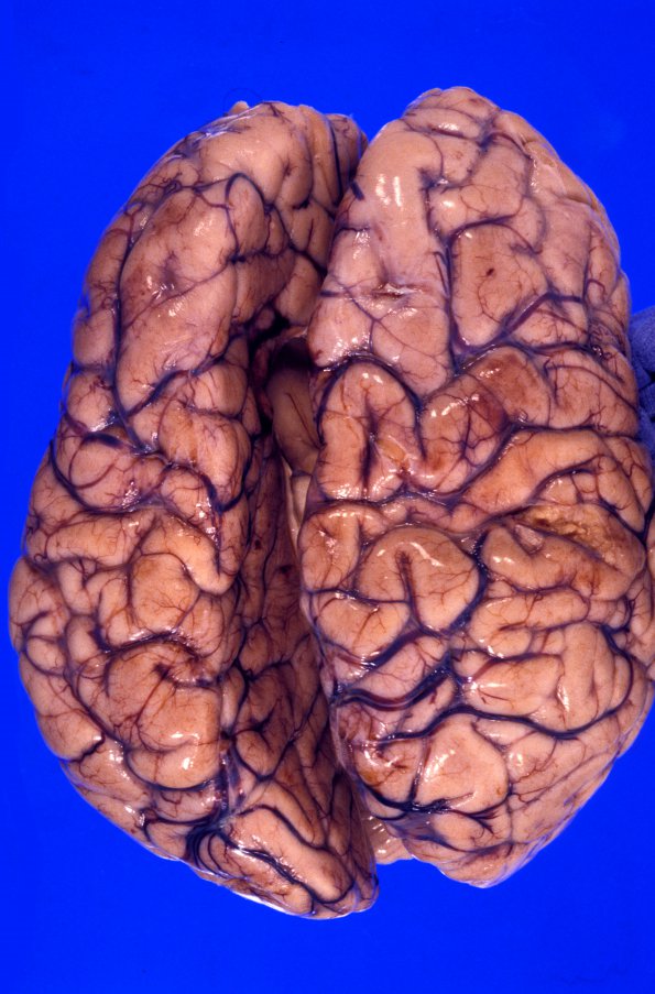 3A3 Mucopolysaccharidosis, Hurler Dz (Case 3) 6